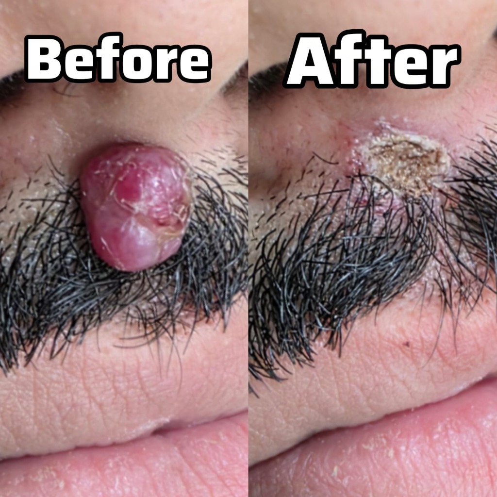 Mole Excision Before After