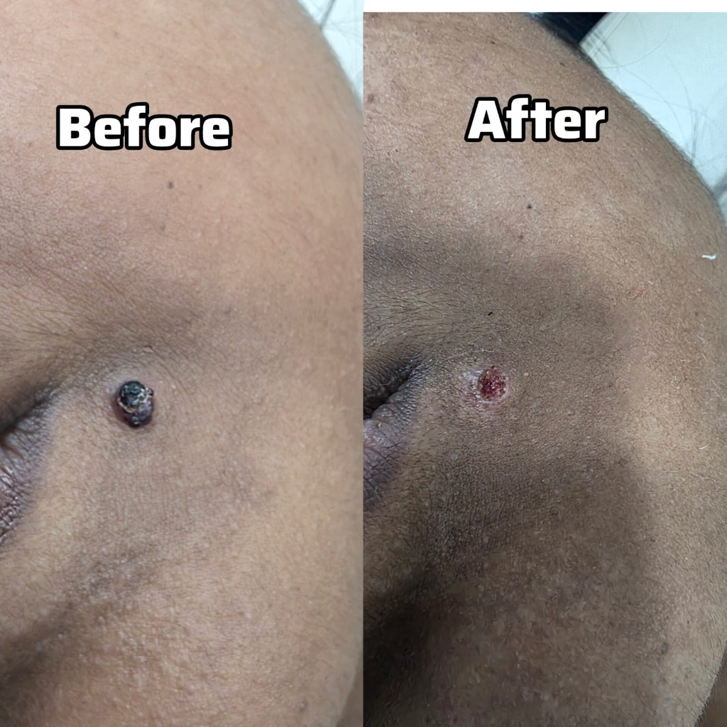 Facial Mole Laser Excision Before After