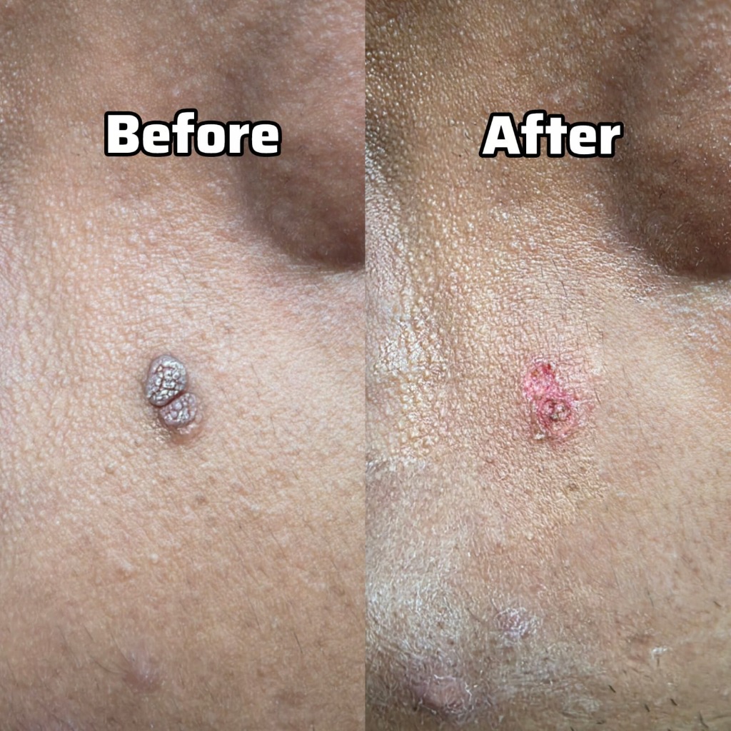 Skin Tag & Wart Removal Before After