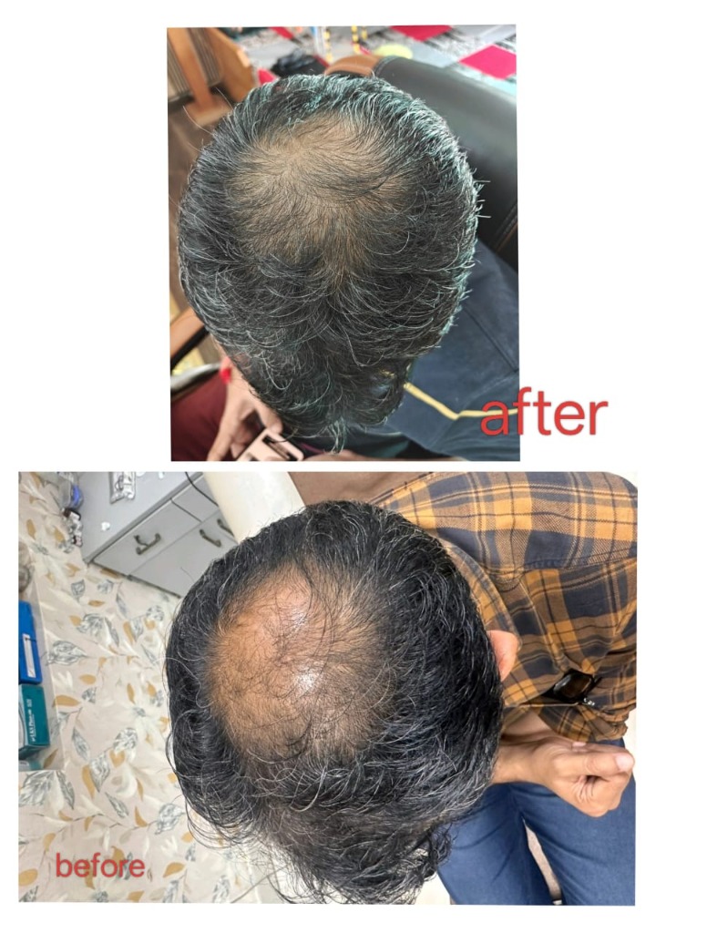Hair PRP Regrowth Before After